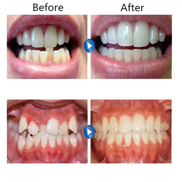 Orthodontic Appliance Silicone Simulation Braces Anti-molar Braces for Night(The third stage) - Dental Tools by PMC TechLife | Online Shopping South Africa | PMC TechLife